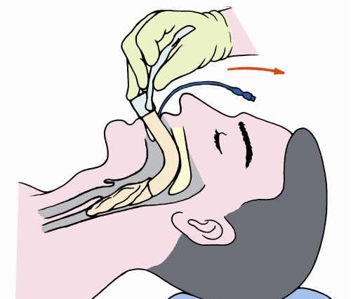 急性颌下腺炎 急性颌下腺炎