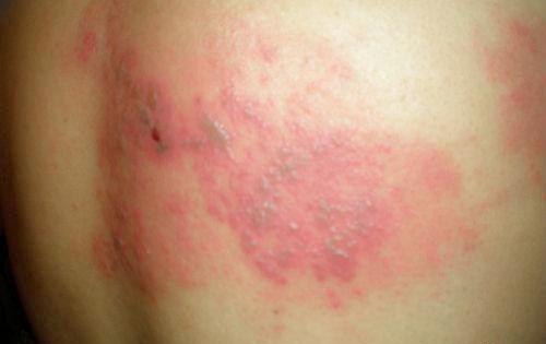 带状疱疹的治疗 带状疱疹的治疗