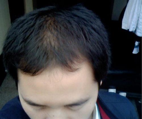 脱发用什么洗发水 脱发用什么洗发水