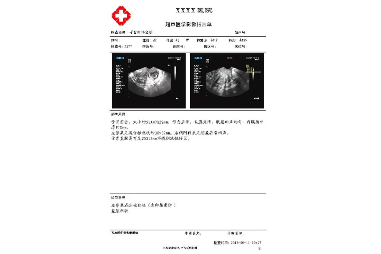 卵巢囊肿诊断证明图片（卵巢囊肿诊断证明图片大全）