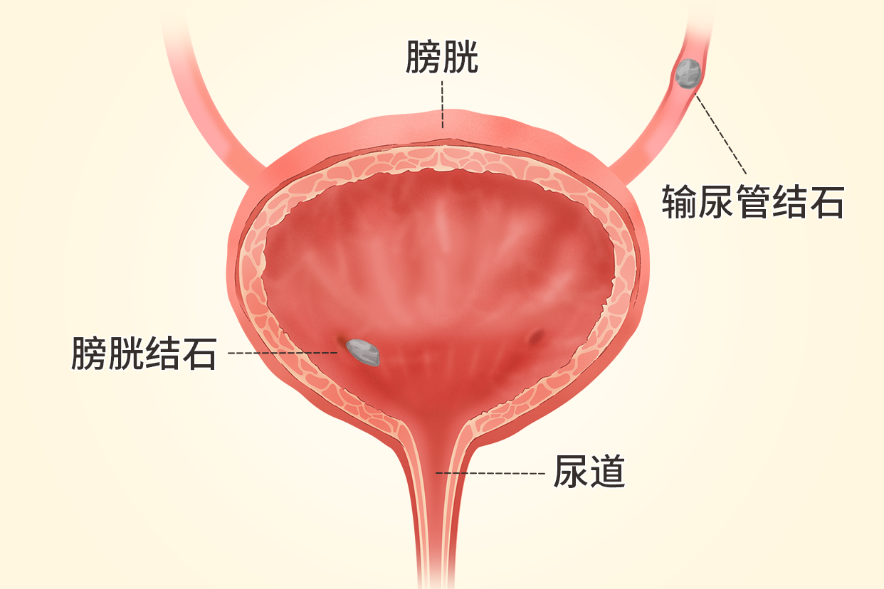 男生膀胱结石在什么位置图片（男生膀胱结石在什么位置图片）