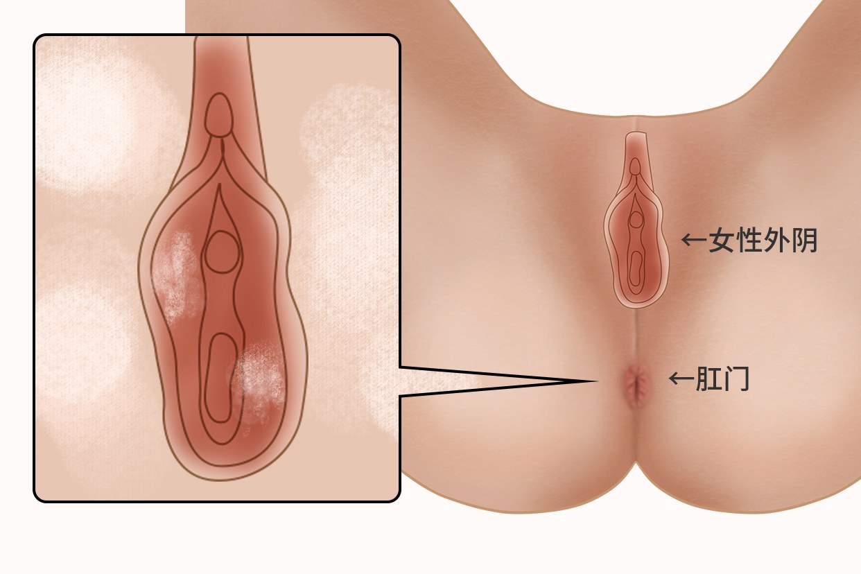 外阴鳞状图片（正常鳞状上皮图片）