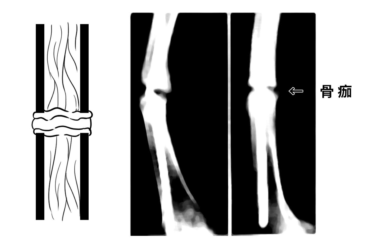 骨痂初期图片（原始骨痂图片）