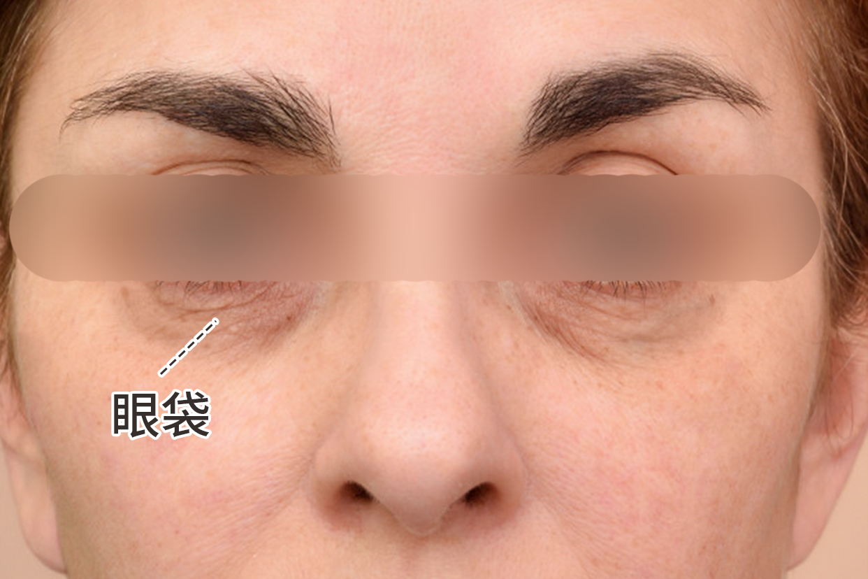 眼袋是什么样的图片 眼袋是什么样子的?