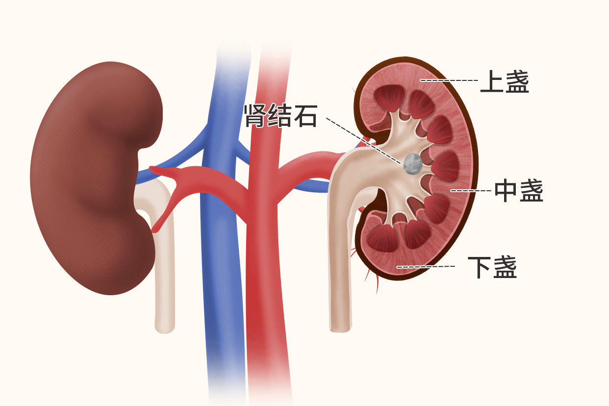 肾中盏结石图片（肾上盏结石图片）