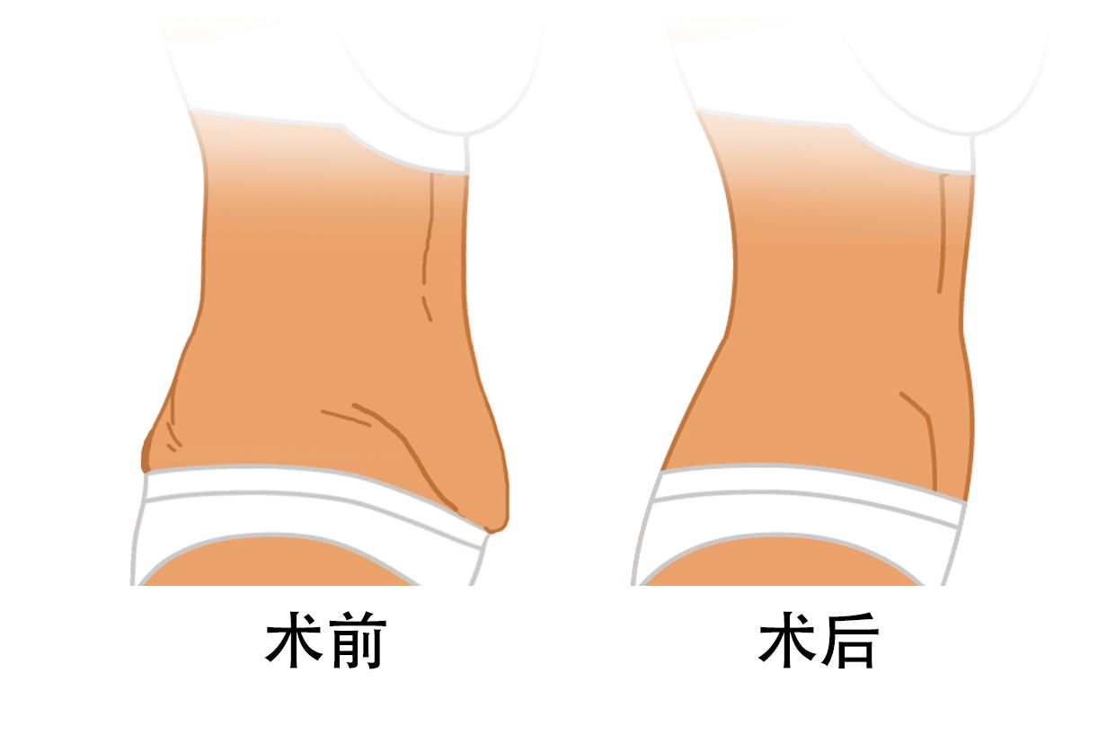 腹壁整形术前后效果图 腹壁整形术前后效果图慈惠腹壁整形经验