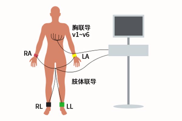 心电图四肢位置图片 心电图四肢位置图片大全