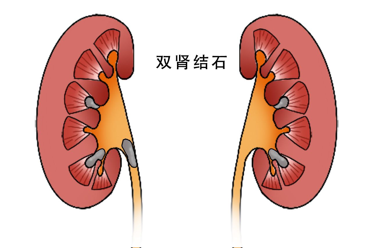 双肾结石图片（双肾结石图片真实）