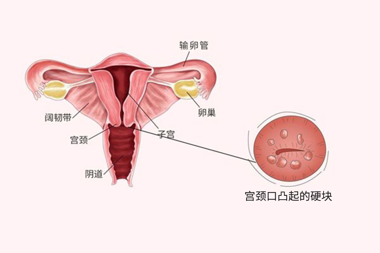 宫颈口摸到凸起硬块不痛不痒图片 宫颈口摸到凸起硬块不痛不痒图片大全