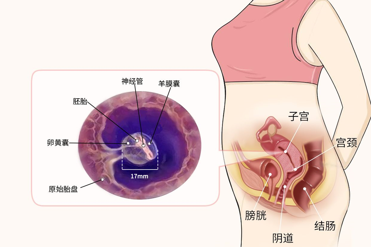 17mm孕囊有多大图片 孕囊大小约18mm17mm