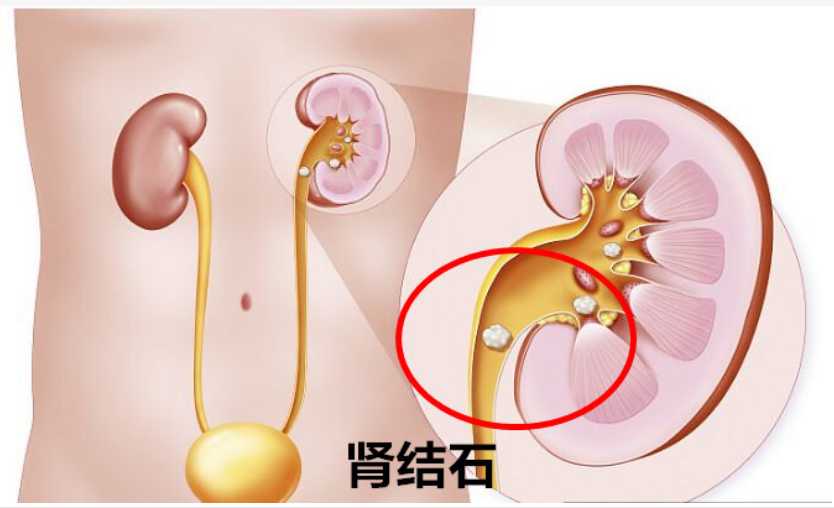 肾结节图片（肾结节是怎么得的）