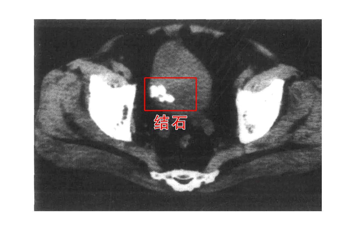 膀胱结石ct图片 膀胱结石x线报告模板