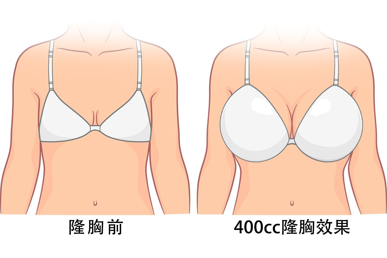 假体隆胸400cc真人图片（假体隆胸400cc真人图片）