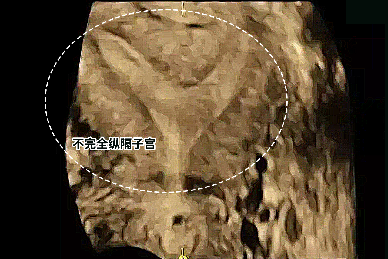 不完全纵隔子宫b超图 不完纵隔子宫和完全纵隔图片