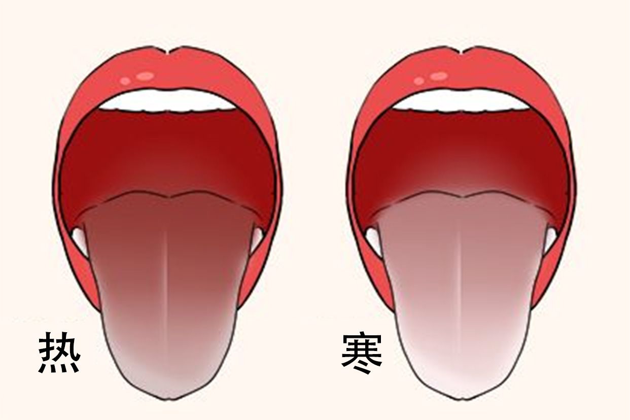 寒热舌象图片（寒热错杂的舌象图片）