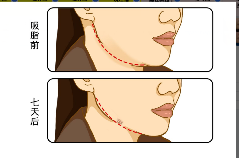 下颌缘吸脂7天恢复图 下颌抽脂七天恢复图