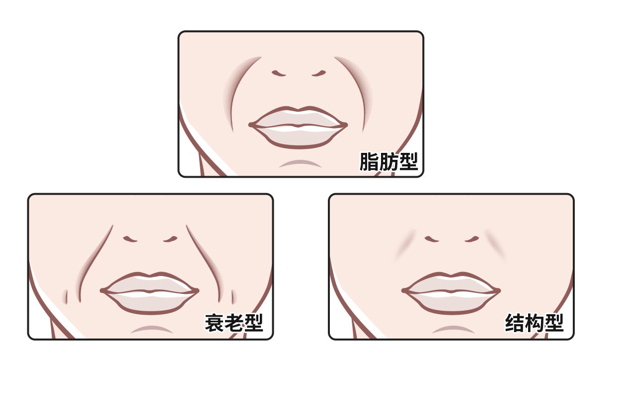 三种法令纹图片 法令纹 图