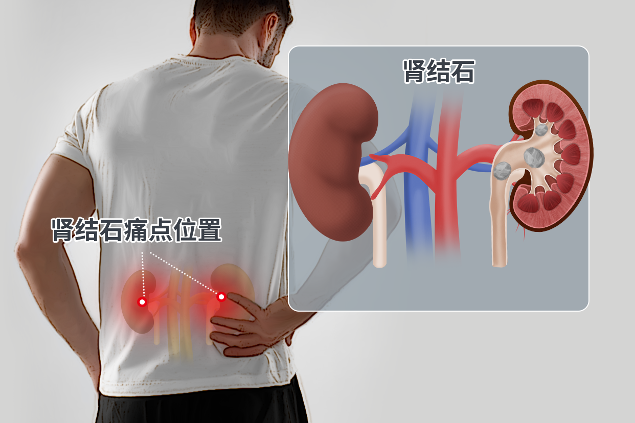 男人肾结石痛点的位置图 男人肾结石在哪边疼图