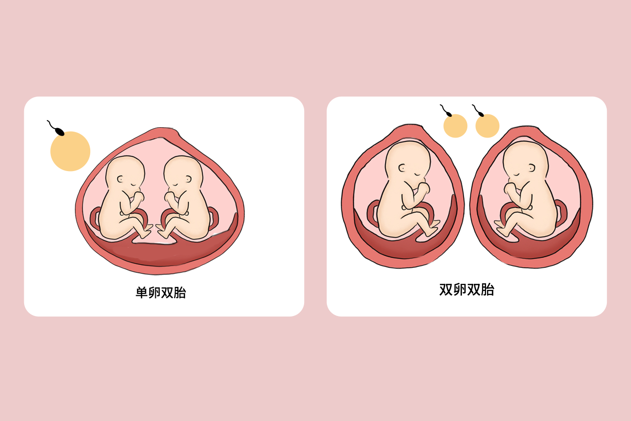 单卵双胎和双卵双胎区别图解（单卵双胎和双卵双胎区别图解视频）