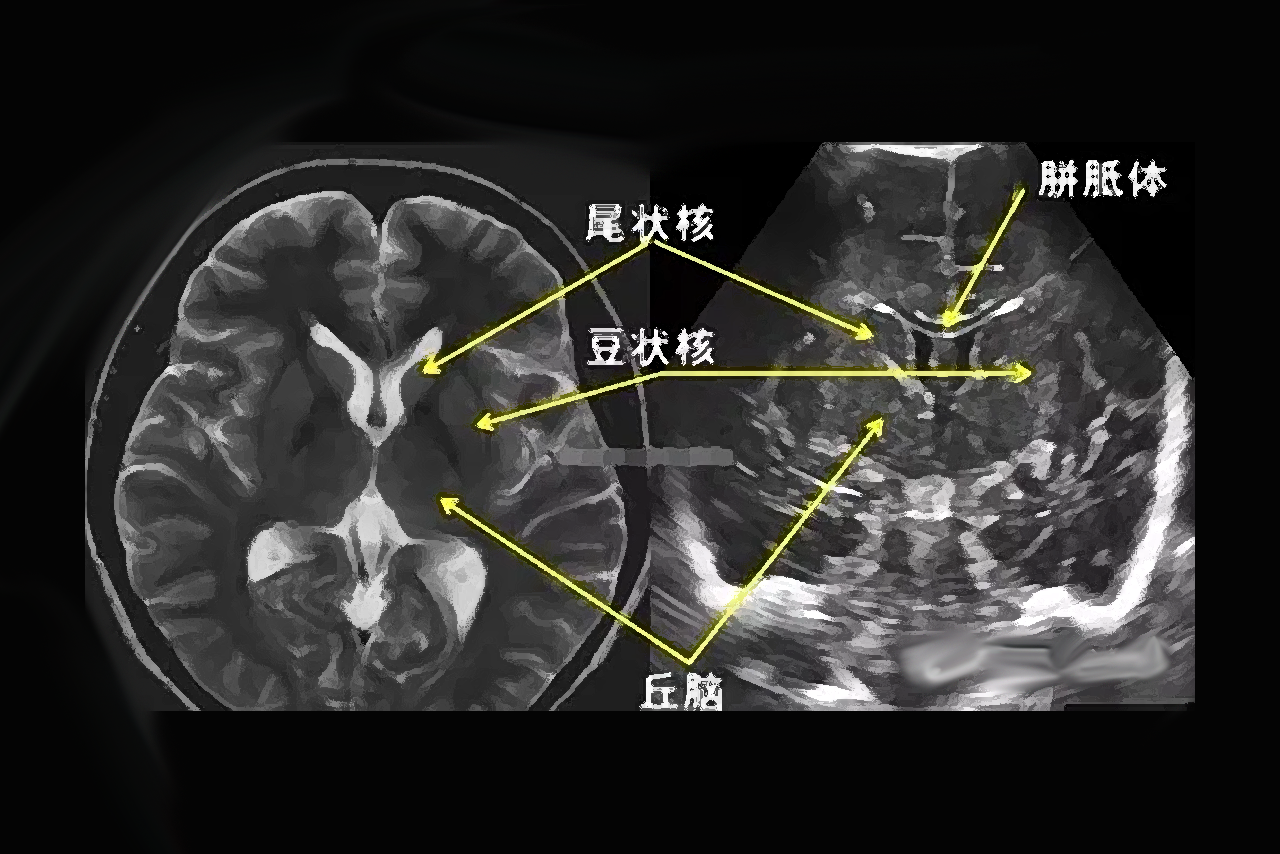 胎儿颅内结构正常超声图谱 胎儿颅内结构超声切面