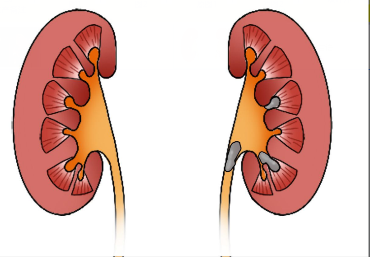 左肾结石图片