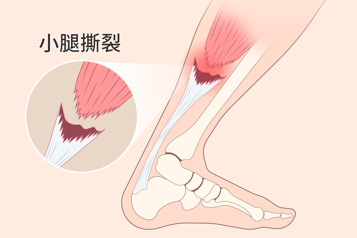 小腿肌肉撕裂图