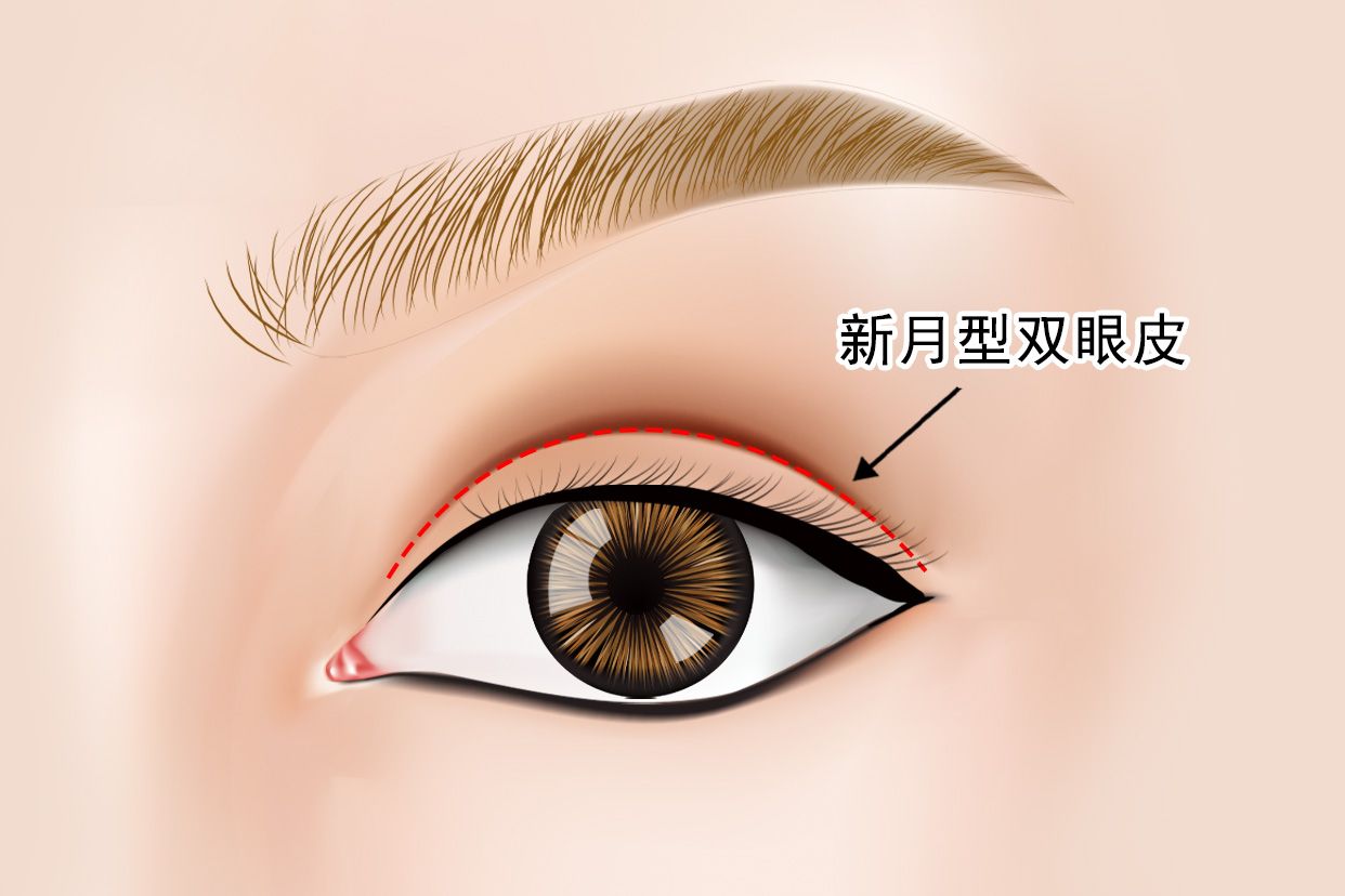 新月型双眼皮效果图 新月型双眼皮效果图