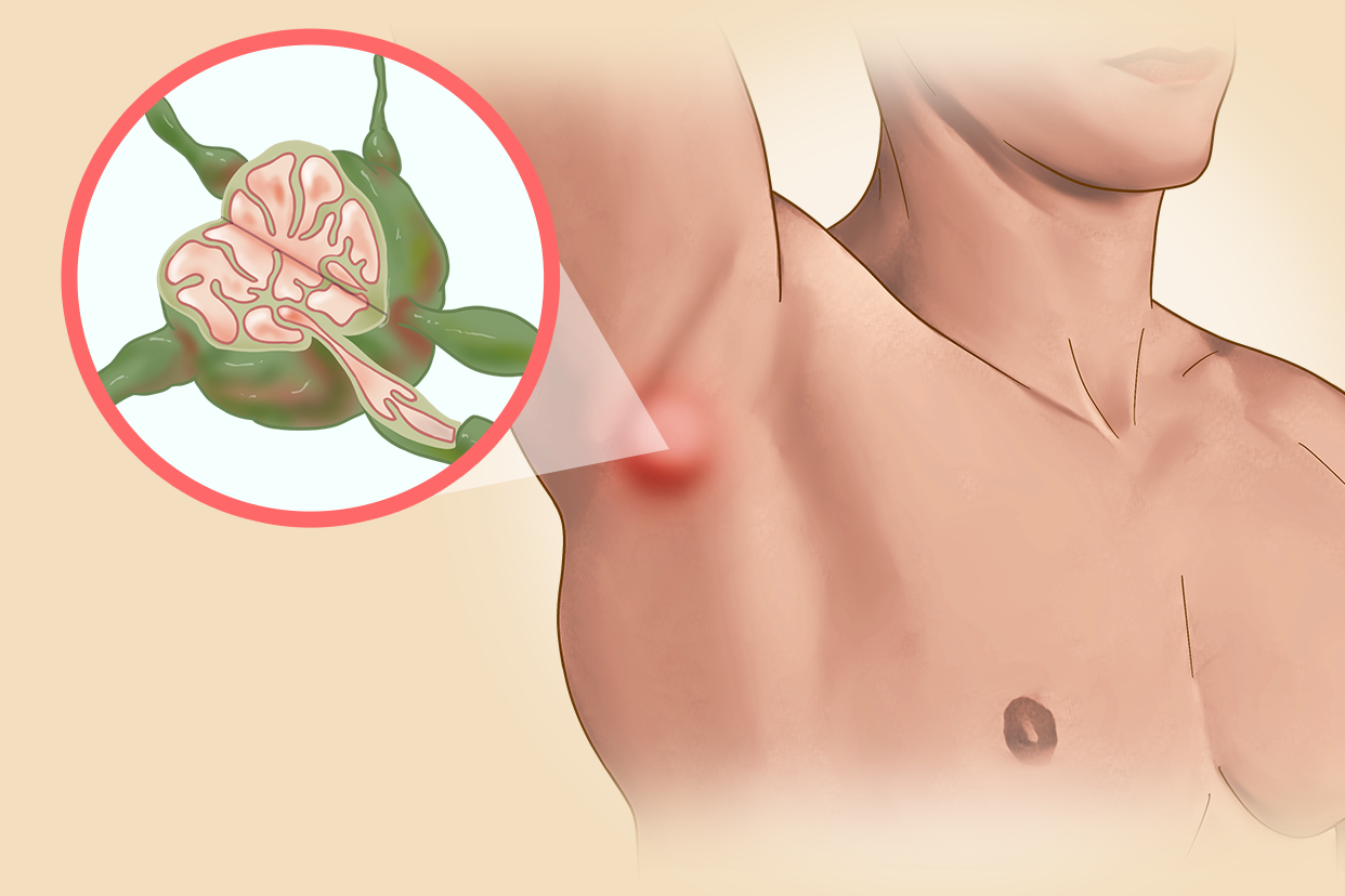 腋下淋巴结发炎图片 腋下淋巴结发炎图片对照