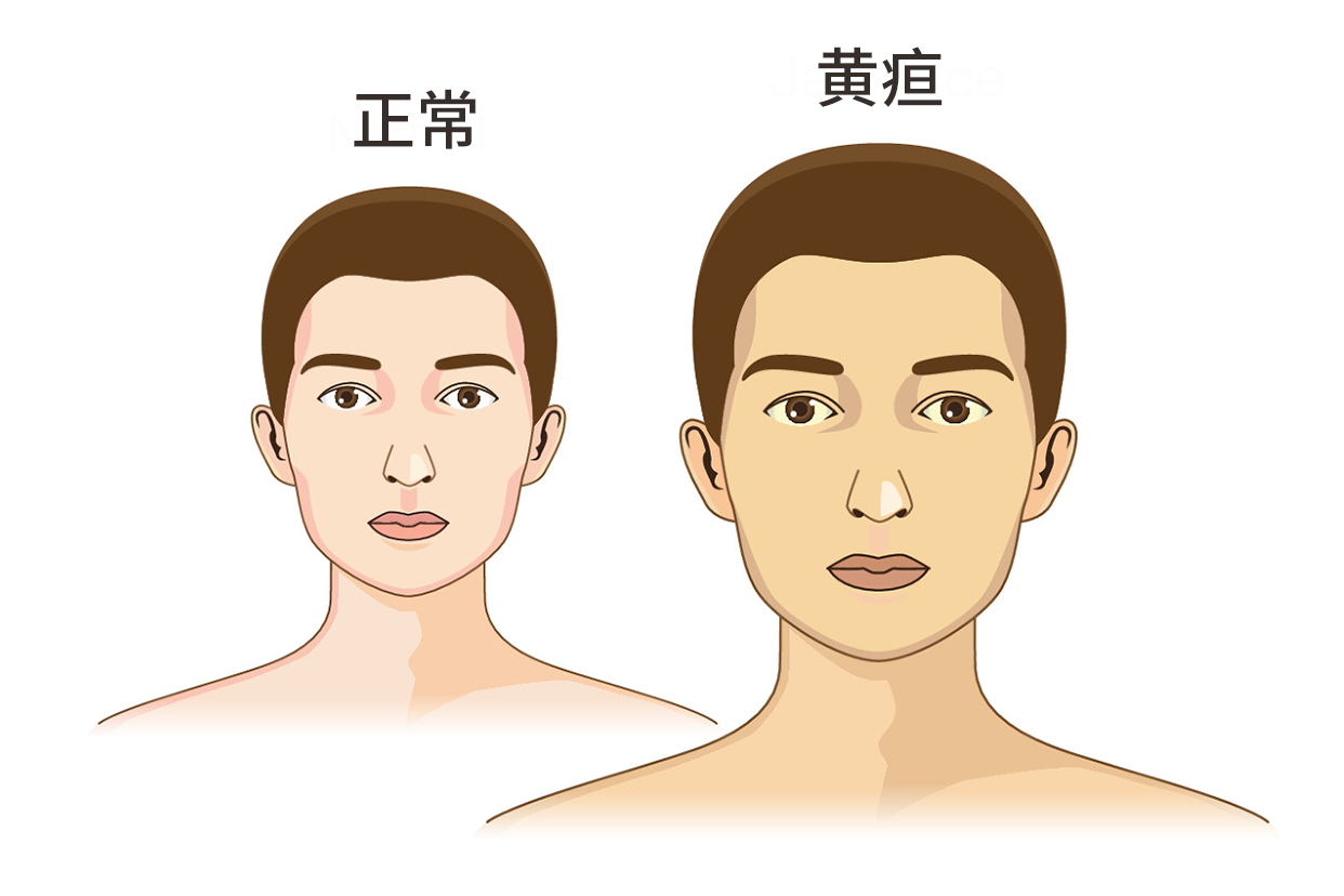 孕妇黄疸的症状图片（胎儿黄疸图片大全）