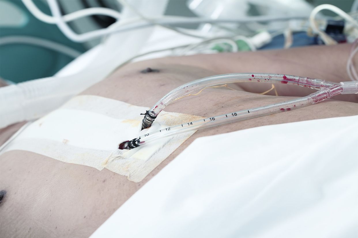 伤口感染了做引流图片（剖腹产伤口感染做引流的图片）