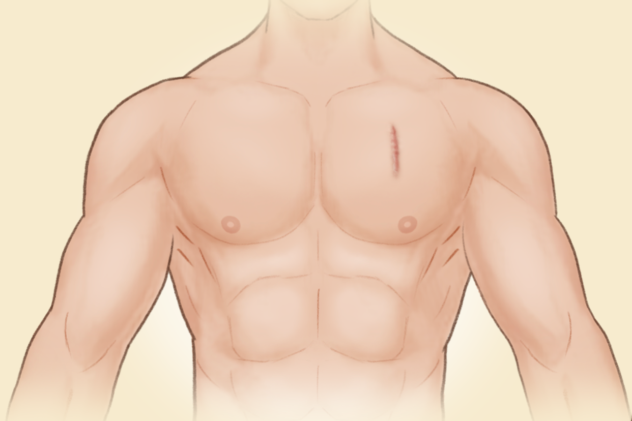 胸部引流管伤口恢复图片 引流管图片 伤口