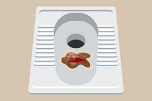 成人痢疾的大便图解 成人痢疾的大便图解图片