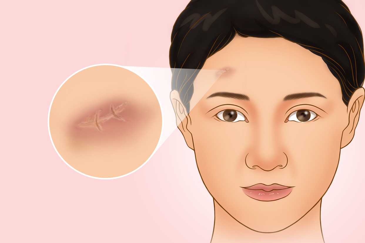 额头拆线后伤口正常图片（额头拆线后的图片）