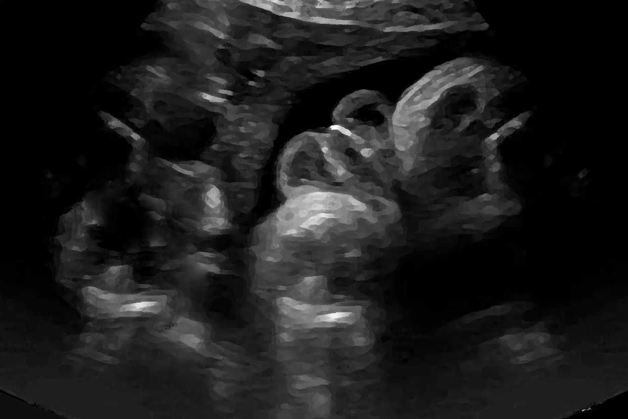 郁金香性尿道下裂图片（郁金香征尿道下裂会不会误诊）