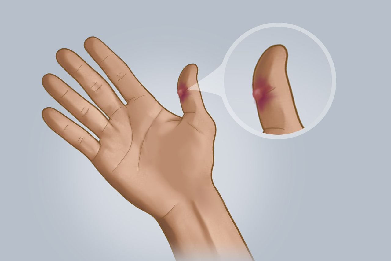 osler结节图片(Osler结节图片)