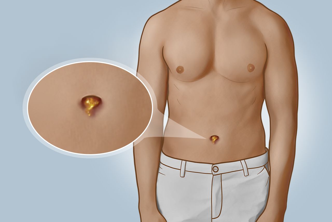 大人肚脐眼发炎出血图片 大人肚脐眼轻微出血