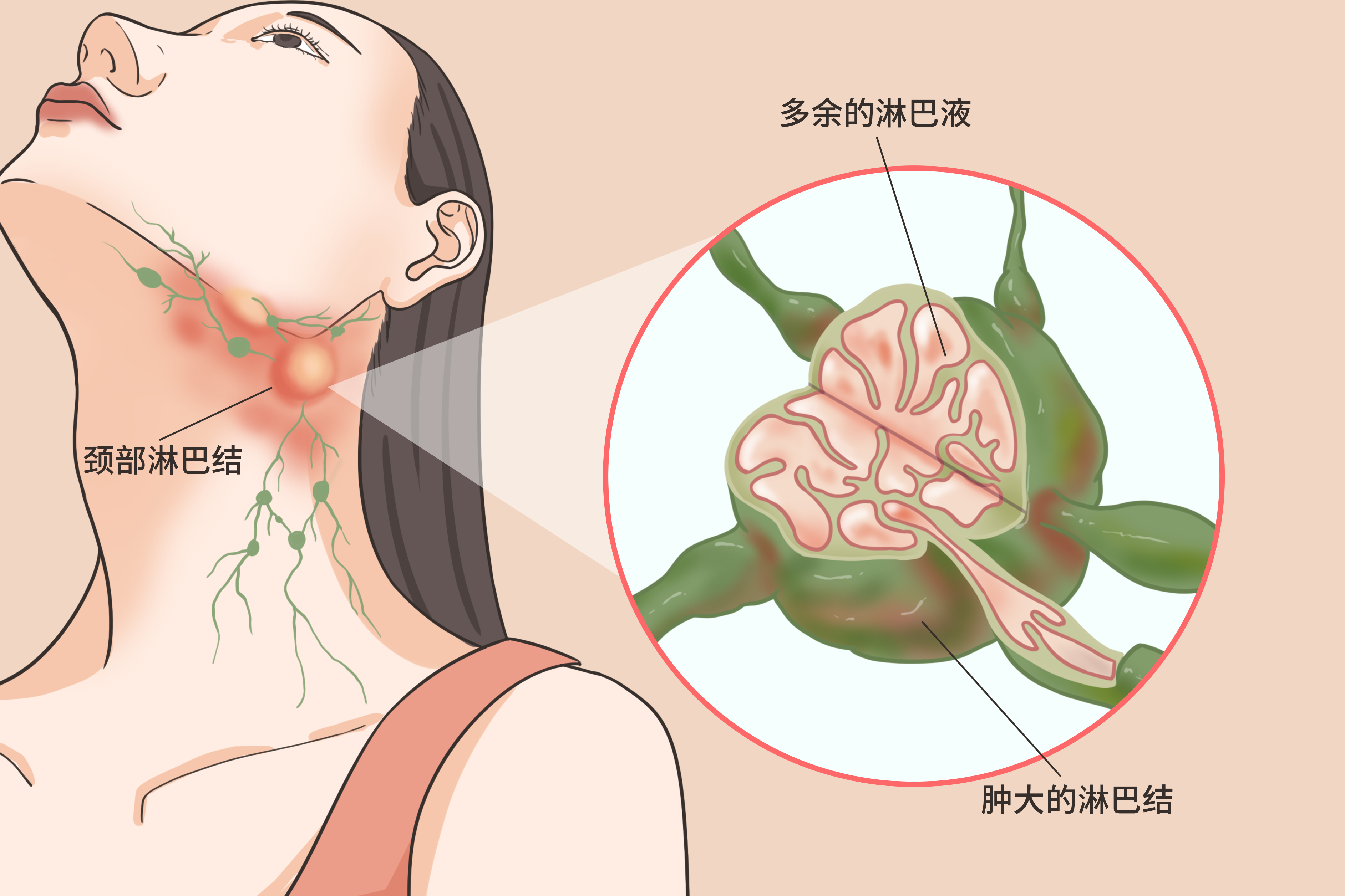淋巴结长什么样子图片 淋巴结长什么样子图片 早期