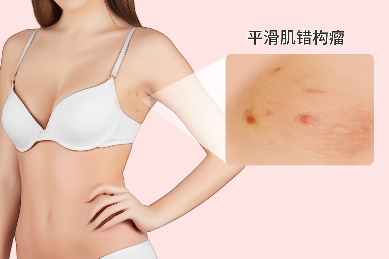 平滑肌错构瘤图片 平滑肌错构瘤好治吗