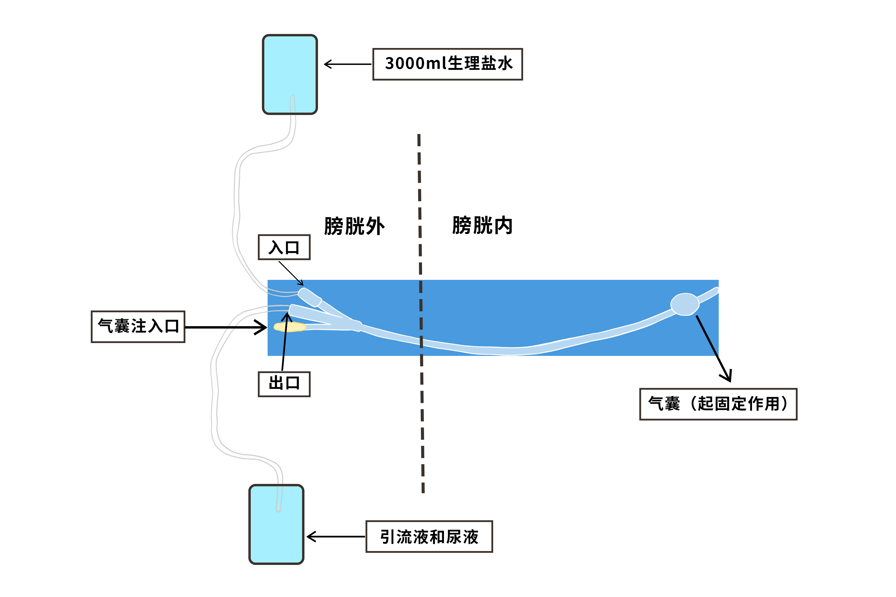 膀胱冲洗接哪个尿管头求图 三个头的导尿管怎么进行膀胱冲洗