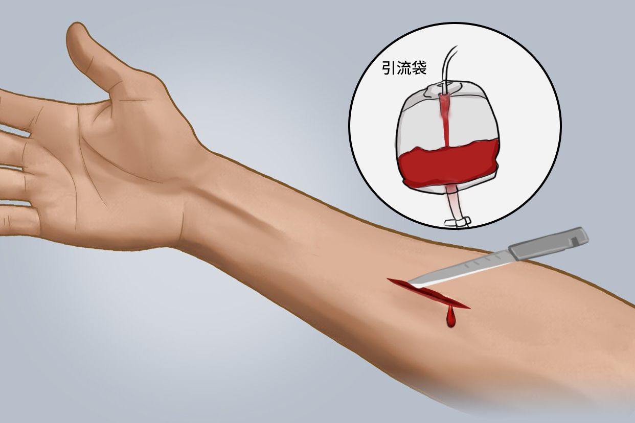 皮下血肿引流手术图片 皮下血肿引流手术图片大全