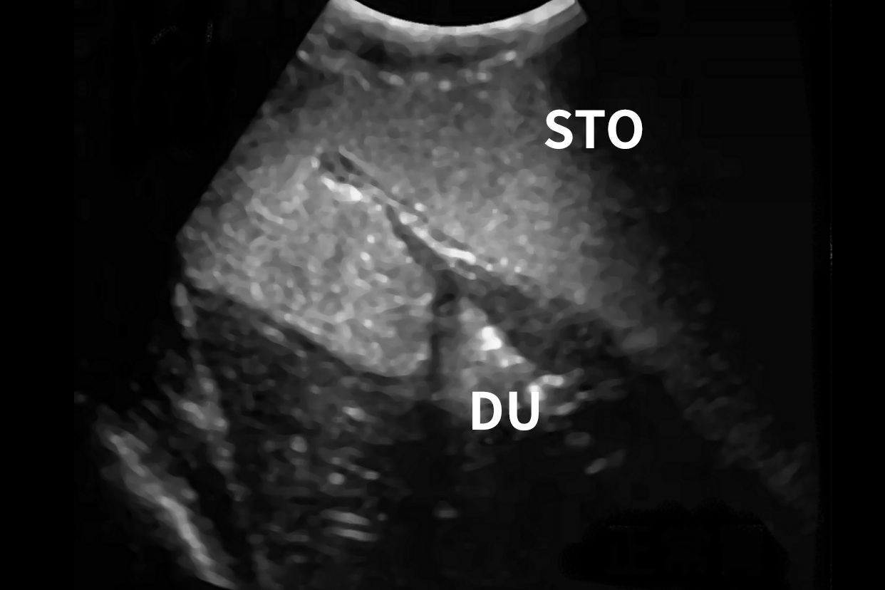 胃部b超图 b超看胃检查报告图片