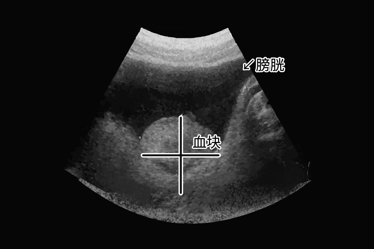 膀胱内血块超声图片 膀胱内血块超声图片大全