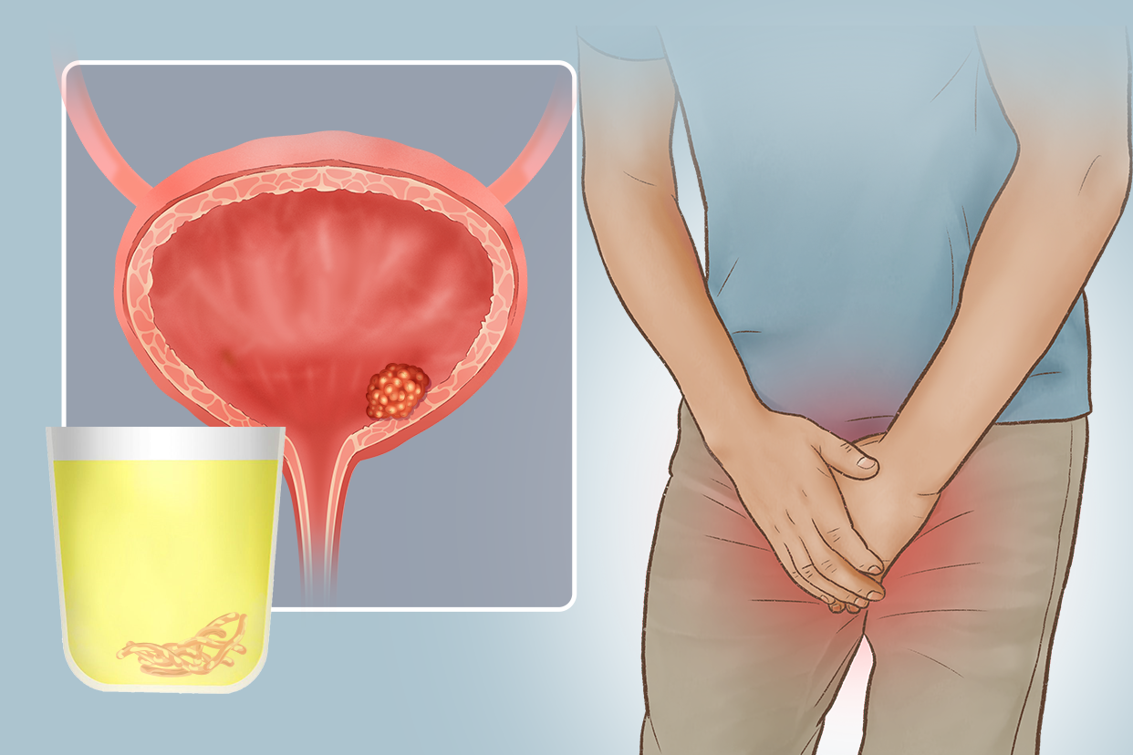 膀胱癌尿出腐肉图片 膀胱癌排出腐肉图片