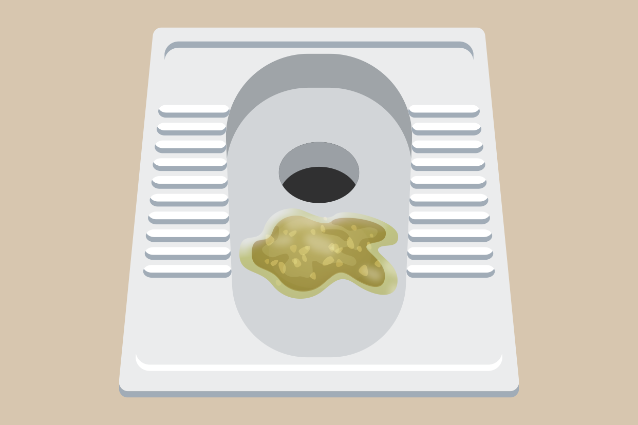 混合喂养拉的全是奶瓣图片 混合喂养大便有奶瓣图片