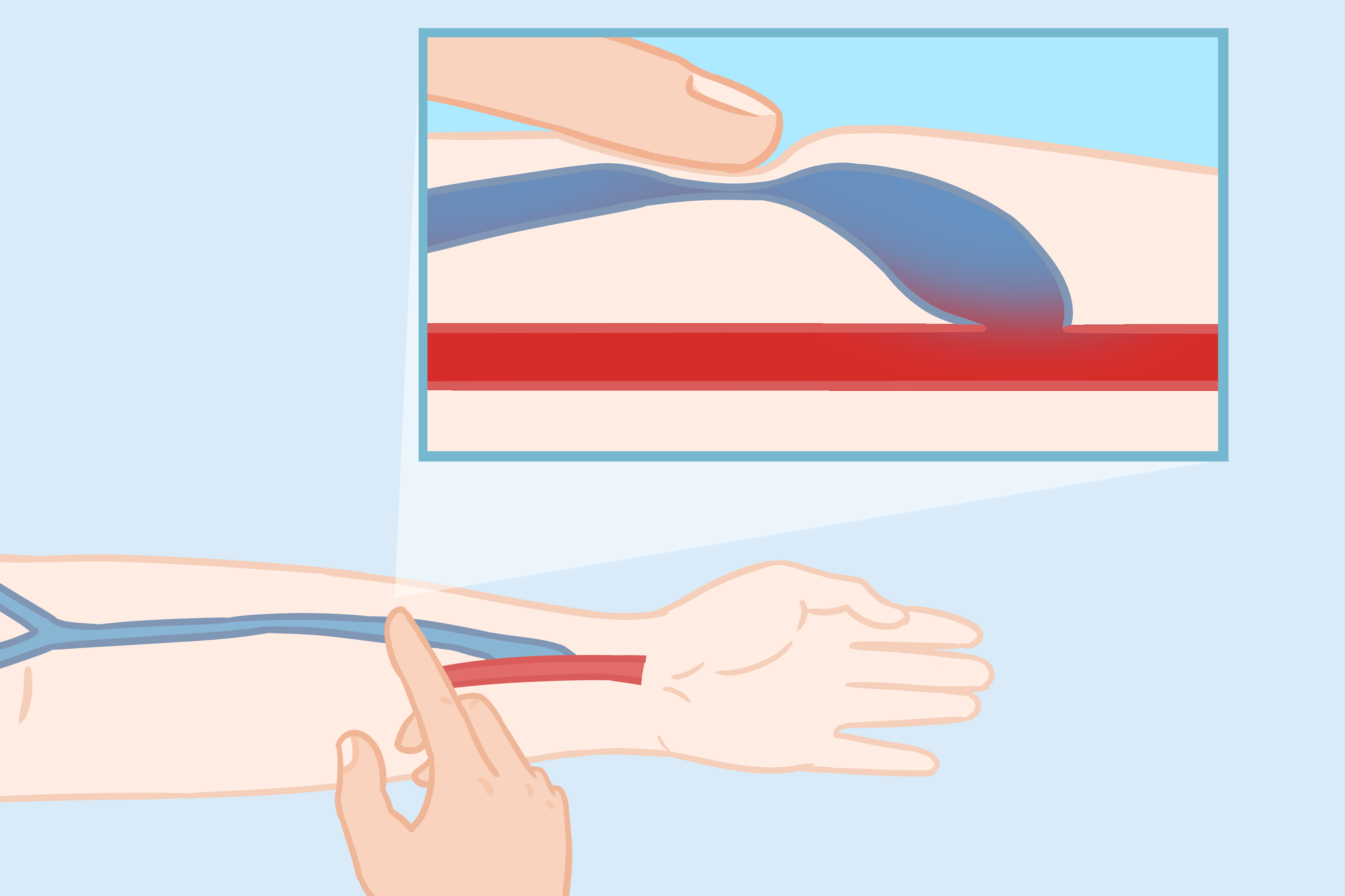 内瘘搏动增强试验图片（动静脉内瘘搏动增强试验图解）