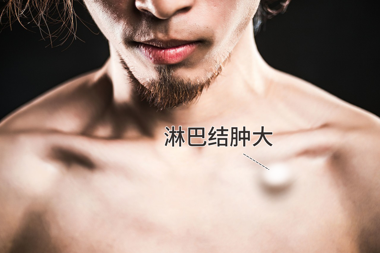 左侧锁骨下方淋巴结肿大图片 左侧锁骨下方淋巴结肿大图片女