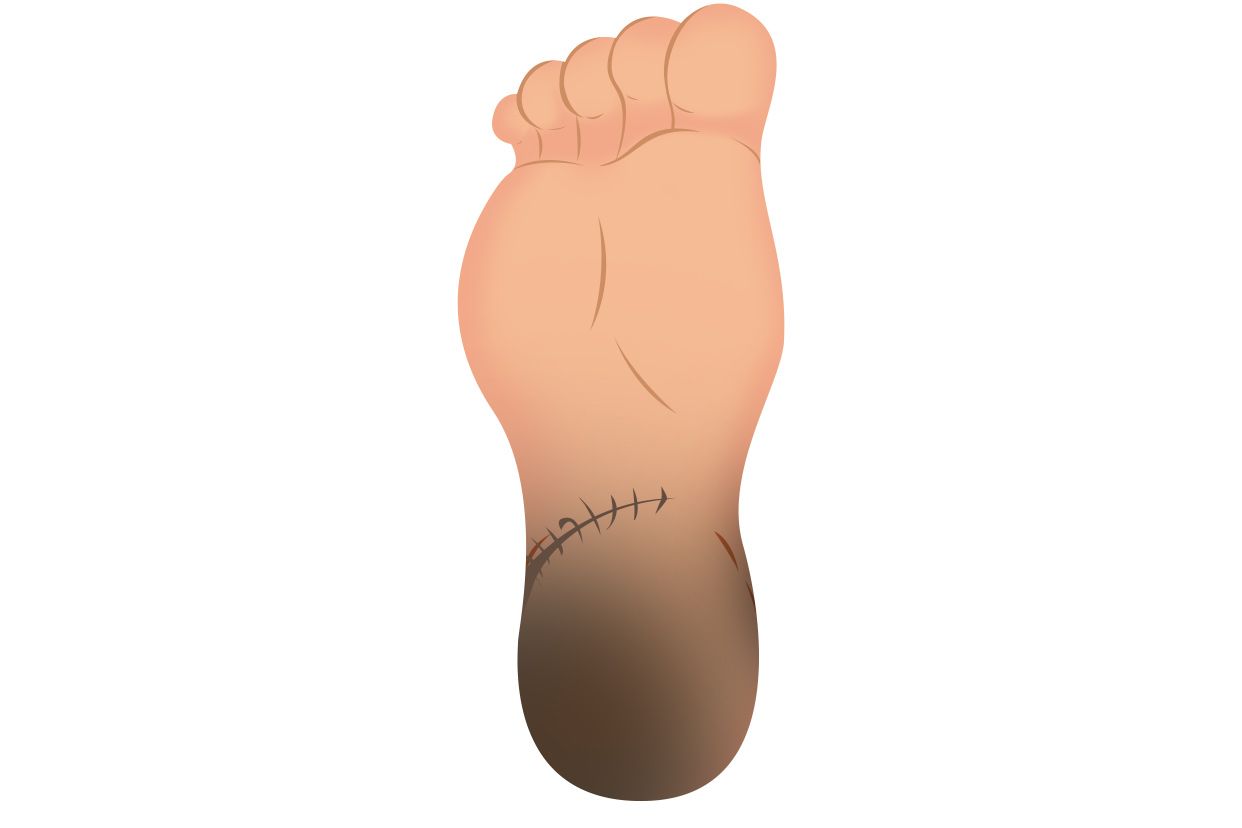 跟骨手术伤口坏死图（跟骨手术伤口愈合图片）