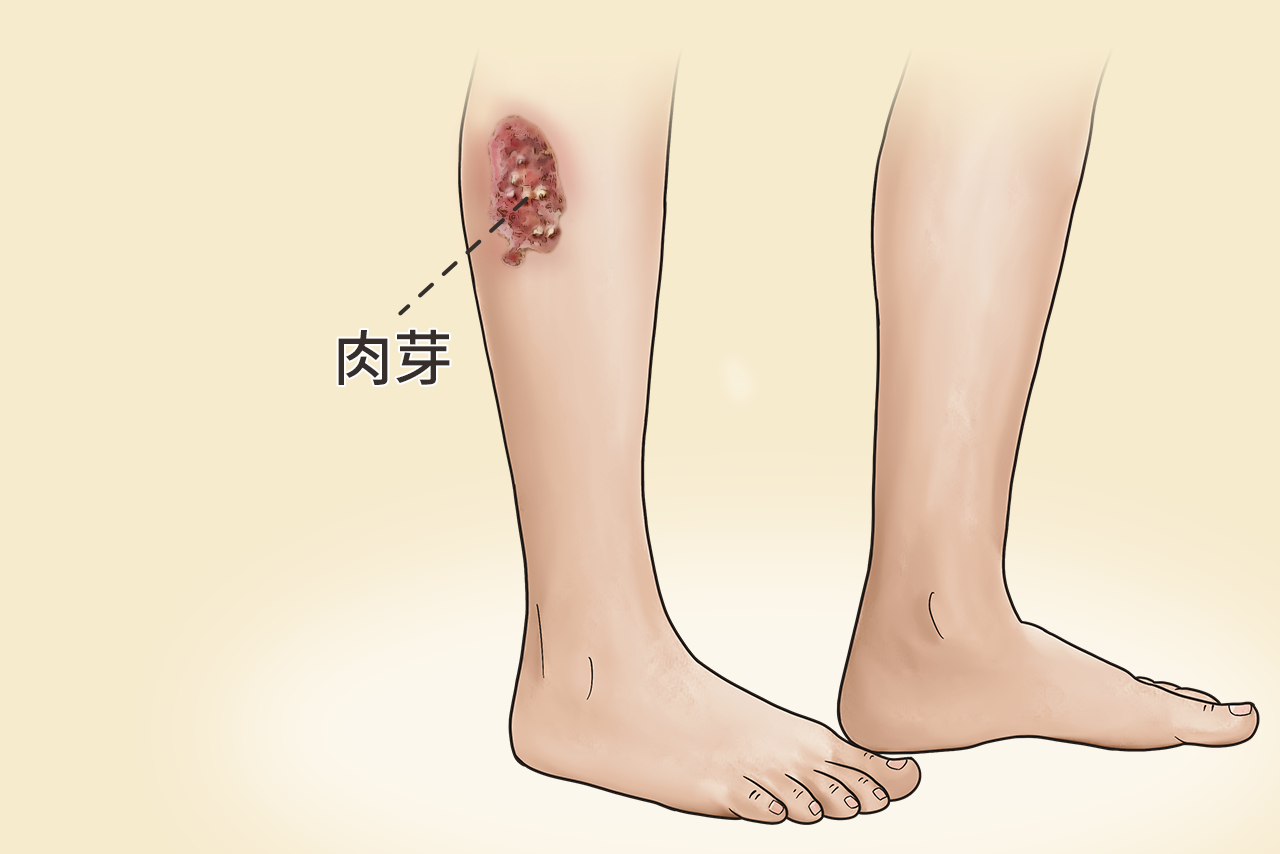 伤口九天肉芽图片(伤口肉芽的图片)