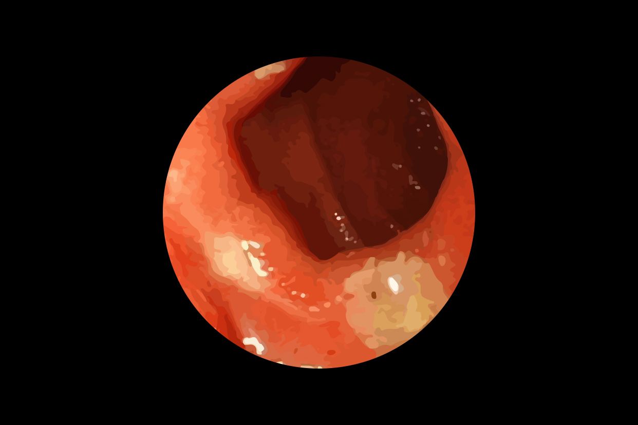 食道结石图片（食道结石图片高清）