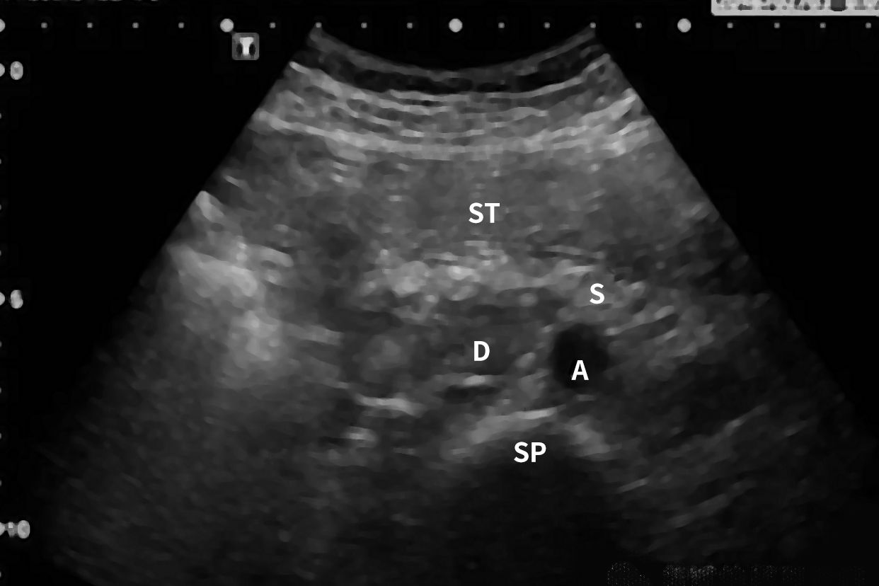 肠系膜上动脉压迫综合征图解 肠系膜动脉压迫综合征的原因